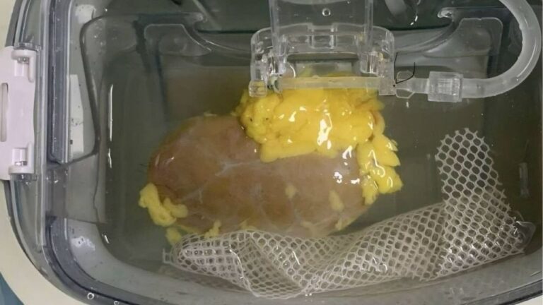 Riñón Universal: El fin de las listas de espera de los pacientes que necesitan trasplantes de órganos