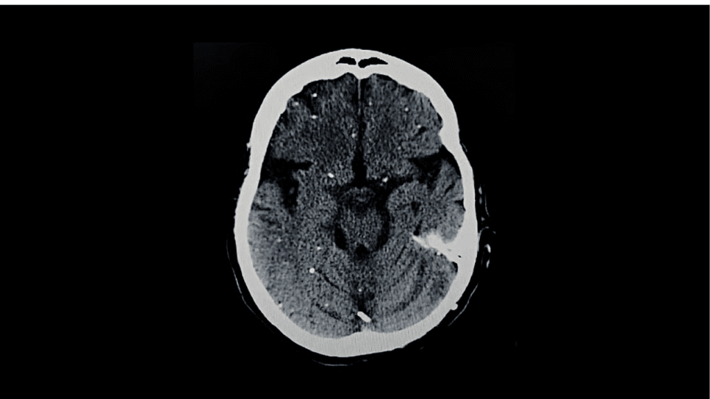 Un parásito cerebral más activo de lo que creíamos: lo que revela la ciencia 2 parasito,cerebral - parasito