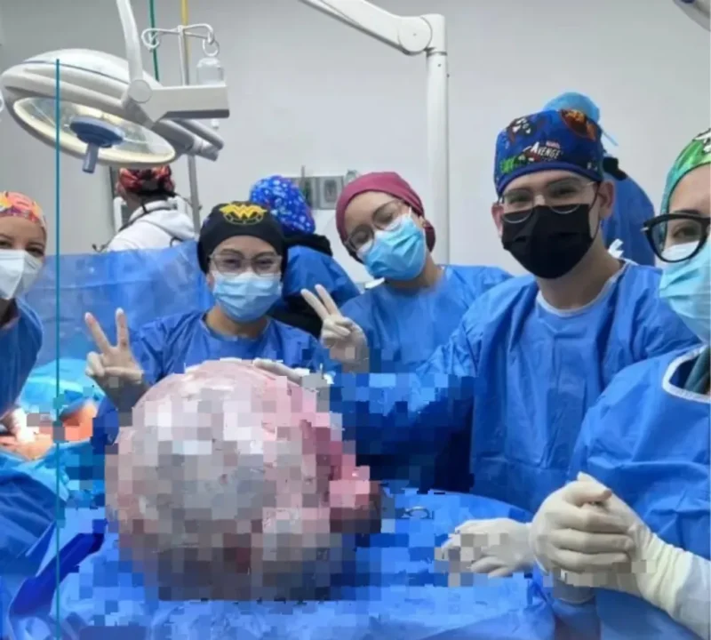 Médicos del Hospital Razetti extraen tumor de 25 kilos a una mujer de 52 años en Venezuela