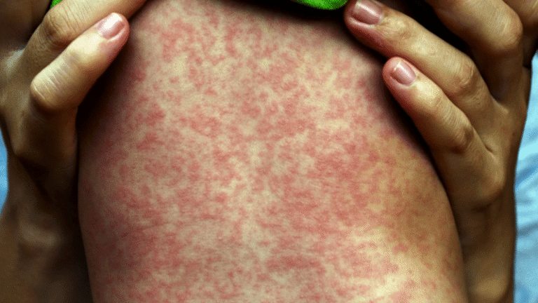 Sin hospitalizados por sarampión en Chihuahua: Salud