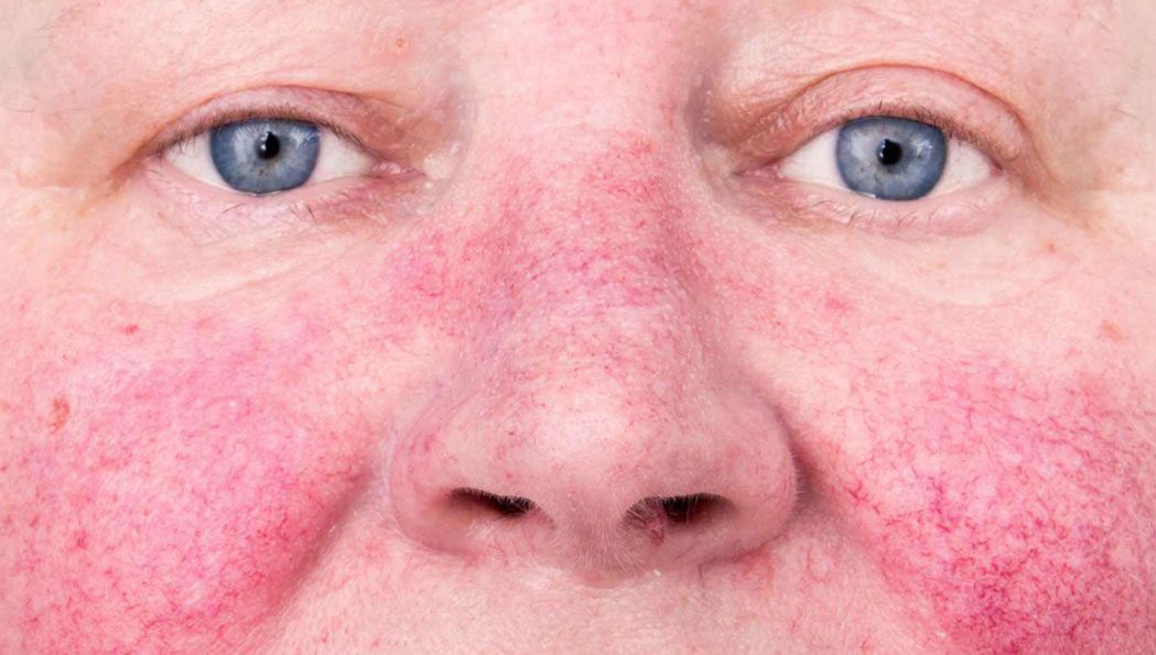 FB Dermatology - ¿Qué es la rosácea?