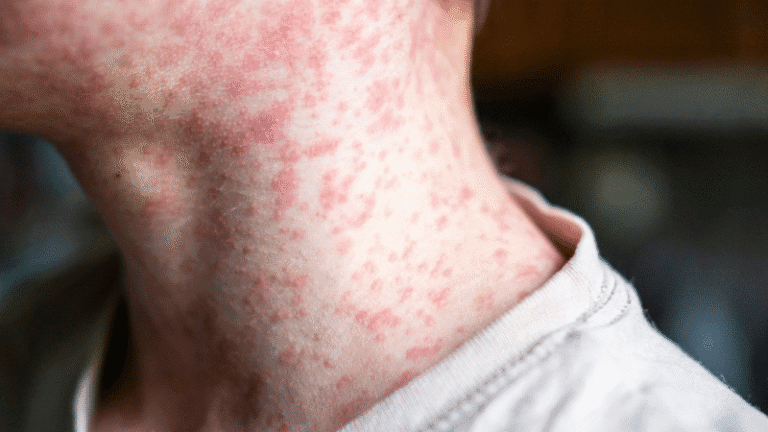 Registra SS 18 casos de sarampión en 13 días