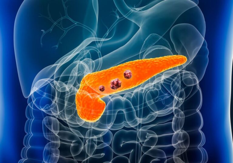 Daraxonrasib: el medicamento experimental que podría transformar el tratamiento del cáncer de páncreas